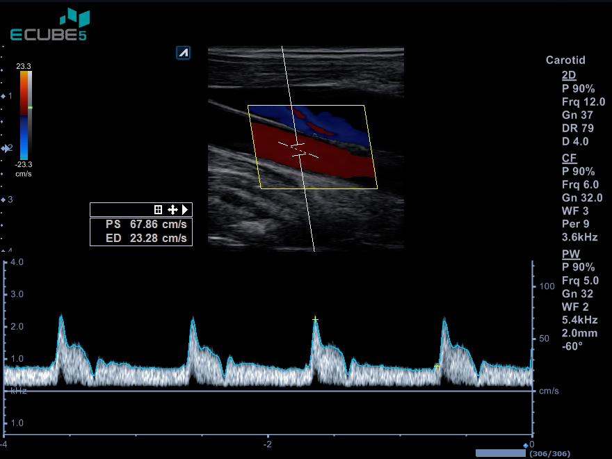 carotid_cf_pw3.jpg